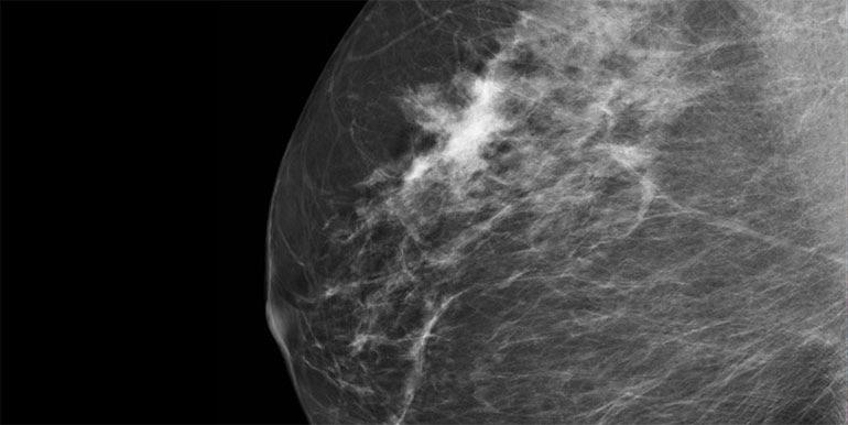 Falešně pozitivní mamogramy možná značí zvýšené riziko vzniku karcinomu prsu v budoucnu