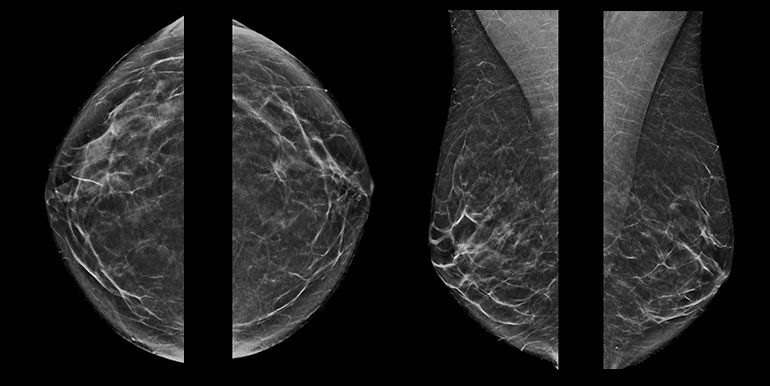 Tomosyntéza prsu nebo digitální mamografie? Obě metody mají v zásadě stejné výsledky