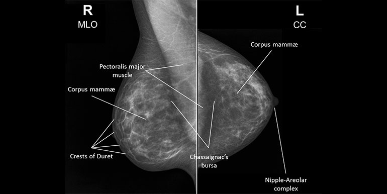 Z mamogramu lze vyčíst, zda tamoxifen jako léčba skutečně zabírá