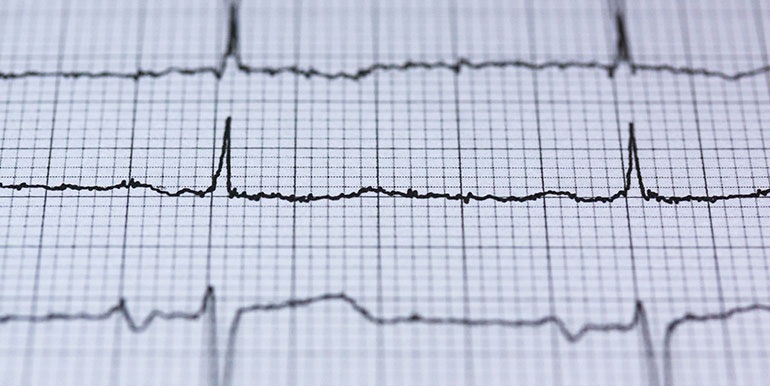 Riziko vzniku srdečního onemocnění v důsledku radioterapie je menší, než se až dosud předpokládalo