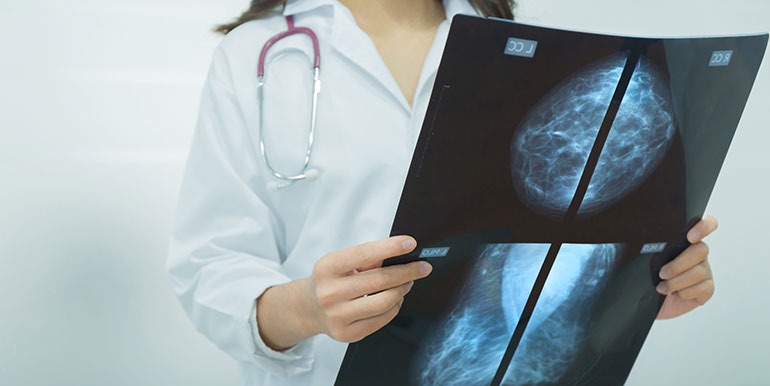 Breast cancer patients with high density mammograms do not have increased risk of death
