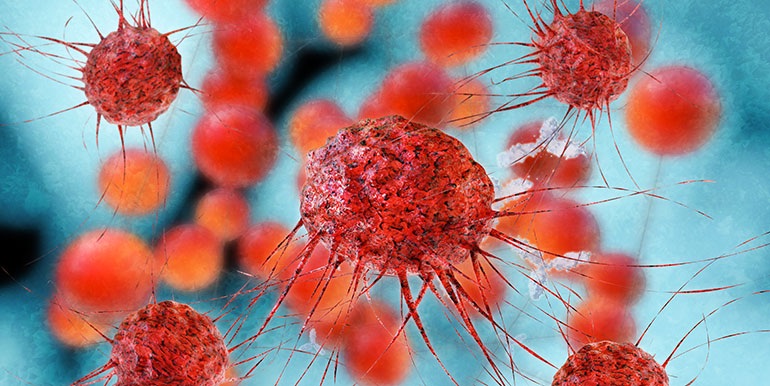 Metastatic breast cancer uses immune system to spread