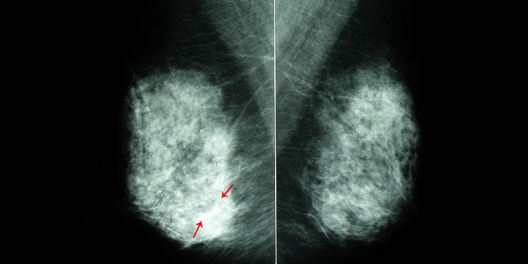 Depozita vápníku by mohla pomoci při diagnostice rakoviny prsu