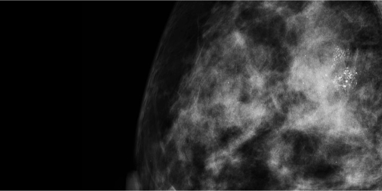 Cell test could predict DCIS breast cancer recurrence