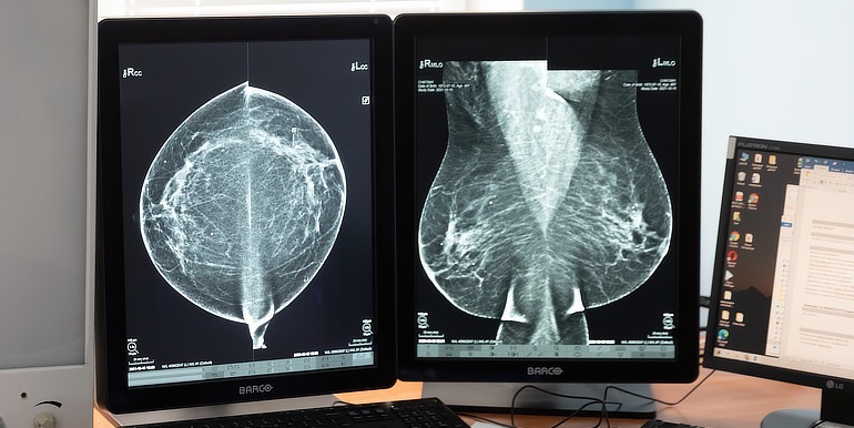 Dovyšetření mamografické abnormality ve screeningu